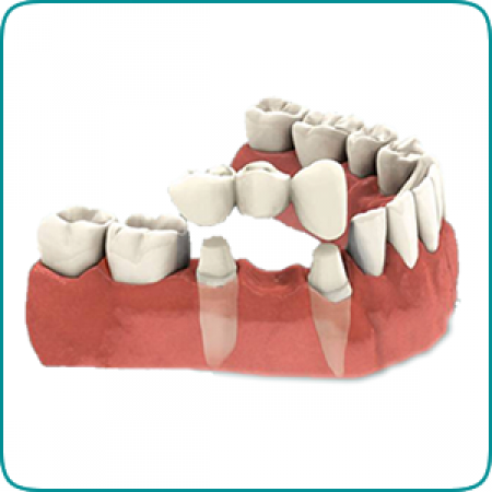 Cabinet stomatologic STOMSAN Dristor - servicii oferite de protetica dentara
